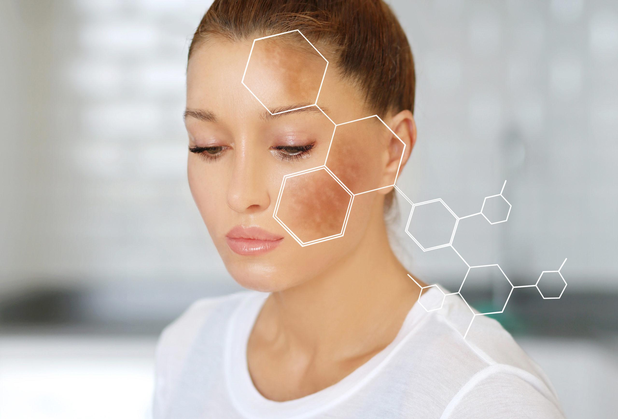 A Path to Clear, Radiant Skin-Chemical Pigmentation