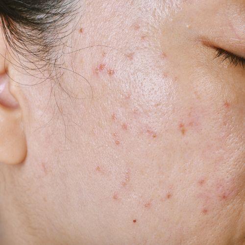 Acne Scar Treatment