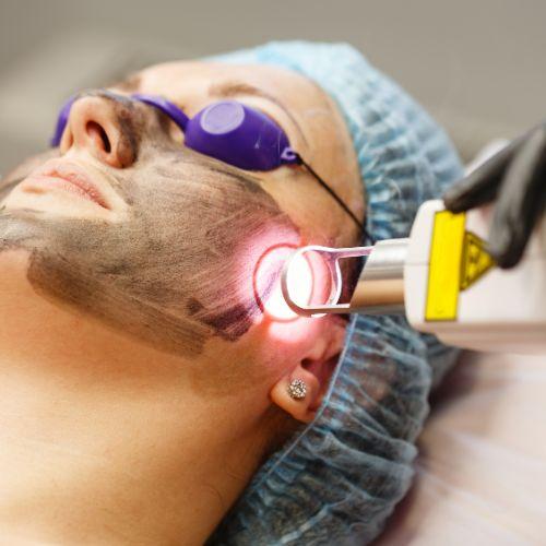 Carbon Laser Toning