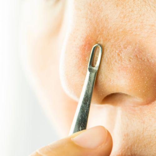 Comedone Extraction (Blackheads & Whiteheads)