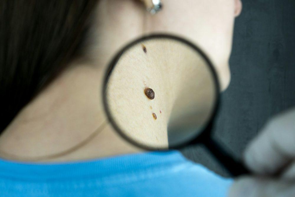 Cyst Treatment