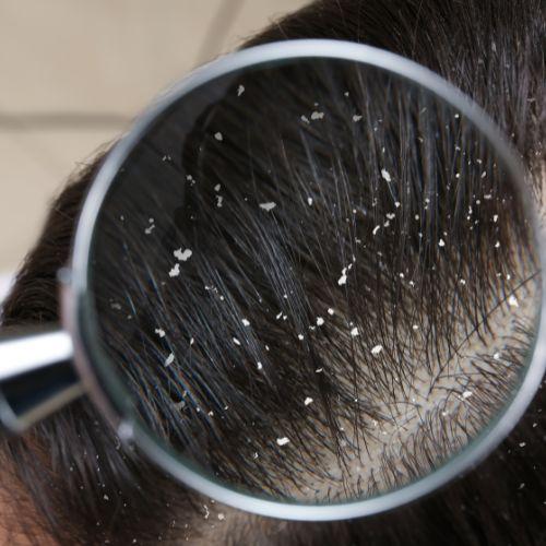 Dandruff Treatment
