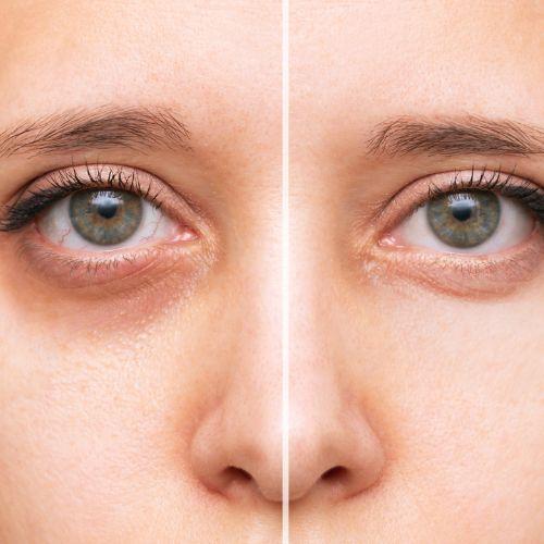 Dark Circle Treatment
