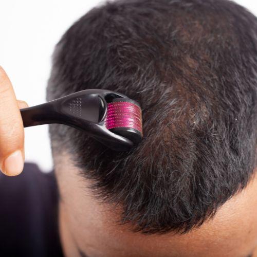 Dermaroller Hair Treatment