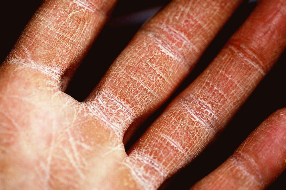 Eczema Treatment