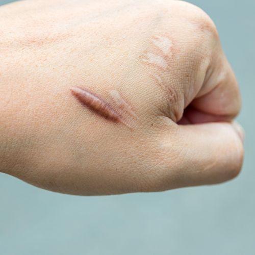 Keloid Treatment