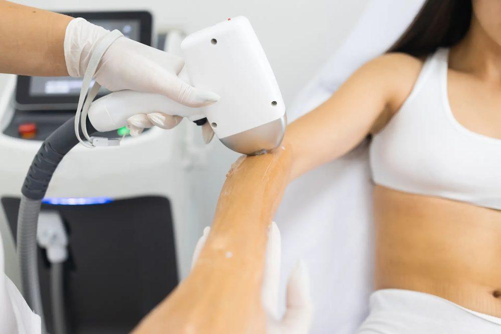 Laser for Keloids
