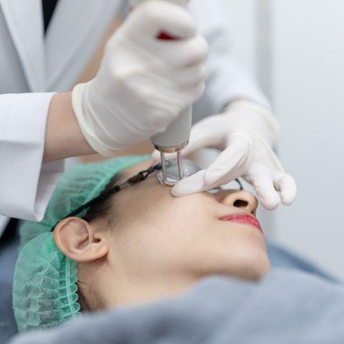 Laser Mole Removal