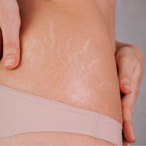Laser for Stretch Marks