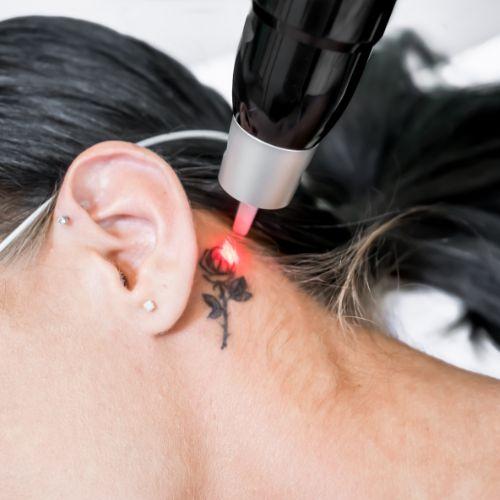 Laser Tattoo Removal