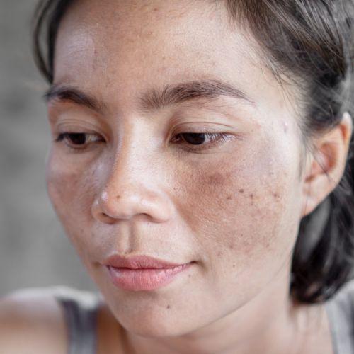 Melasma Treatment