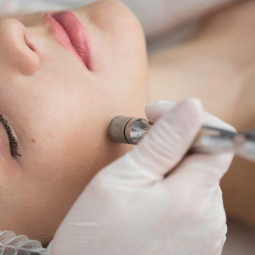 Microdermabrasion