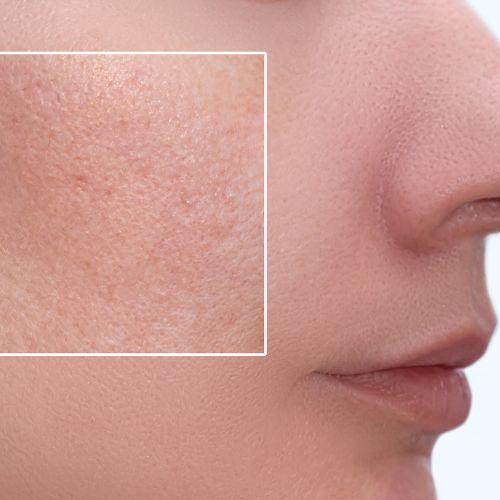 Open Pores Treatment