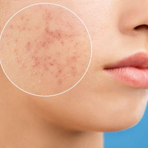 PCOD Skin Treatment