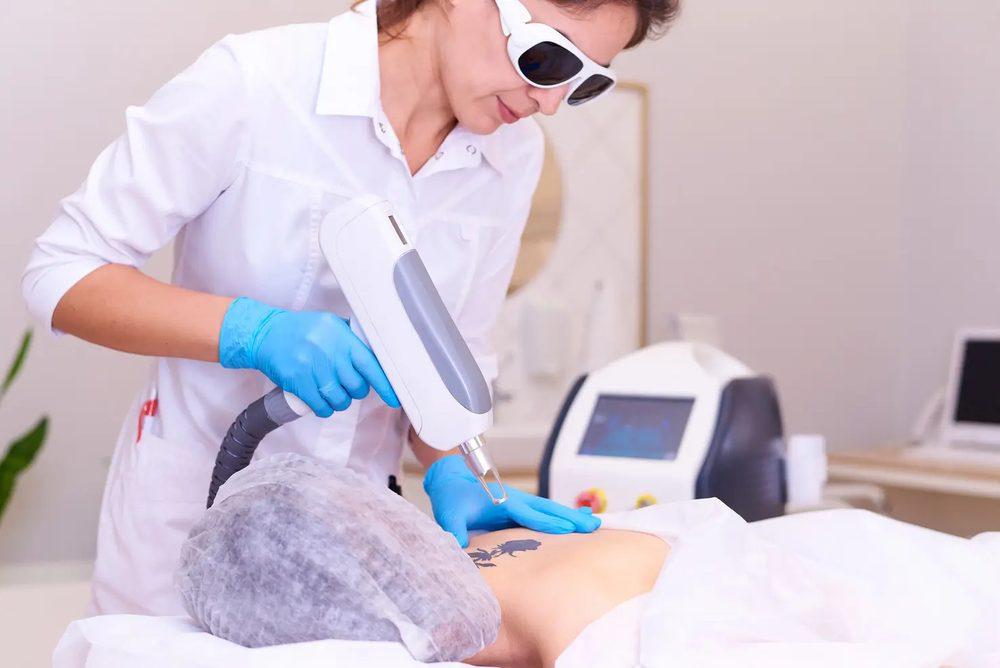 Pigmentation Laser
