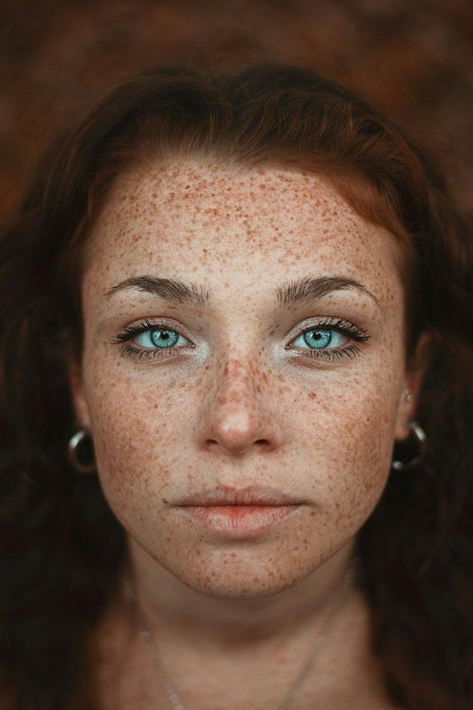 Pigmentation Treatment