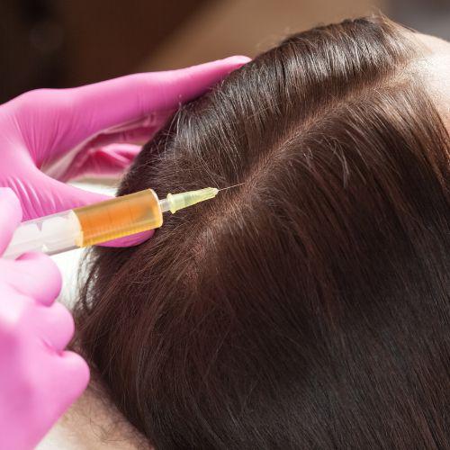 PRP Hair Treatment