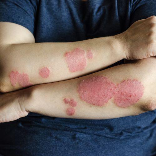 Psoriasis Treatment