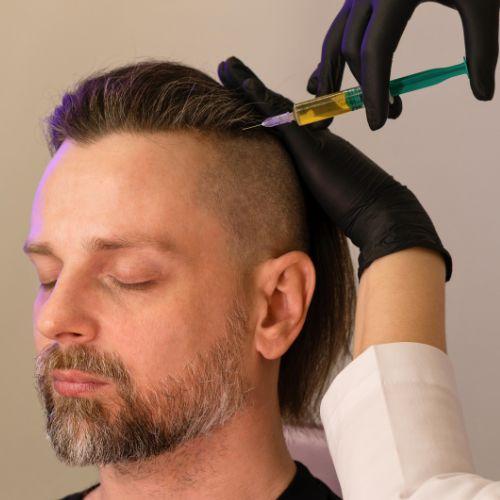 Scalp Mesotherapy