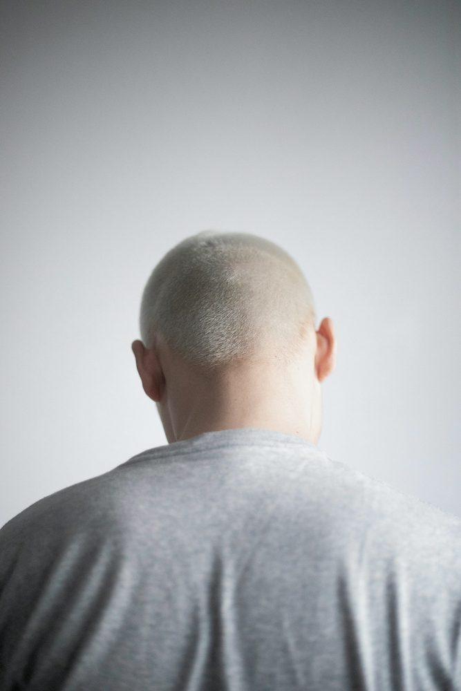 Scalp Micropigmentation