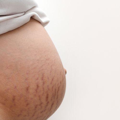 Stretch Marks Treatment
