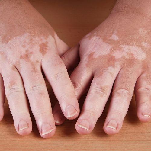 Vitiligo (White Patches) Treatment