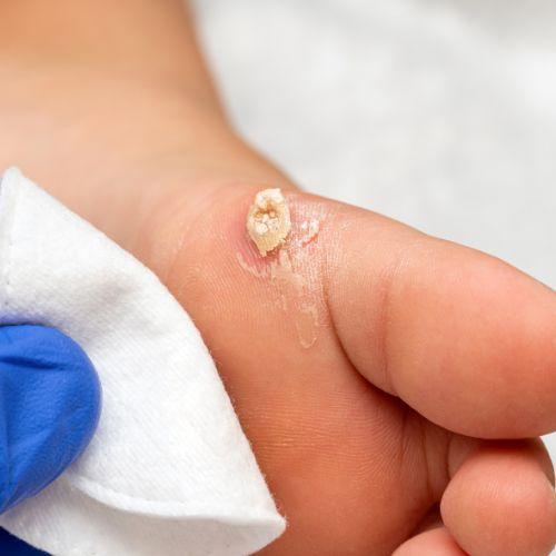 Wart Removal