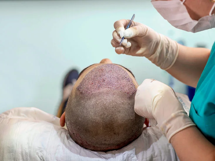Unveiling the Strip Hair Transplant Procedure