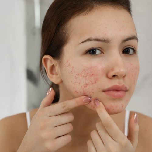 Acne / Pimple Treatments