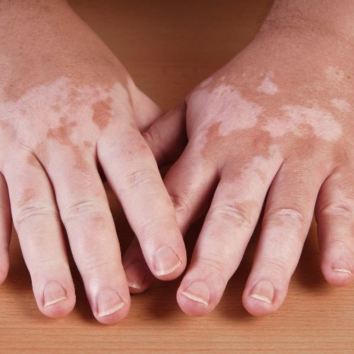 Vitiligo (White Patches)