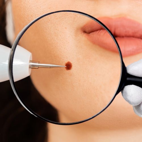 Laser for Mole Removal​