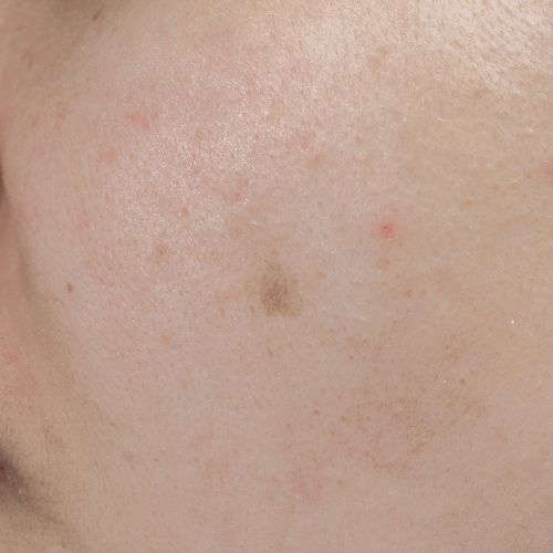 Dark Spots Reduction Treatment