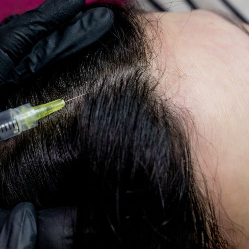 Scalp Mesotherapy​