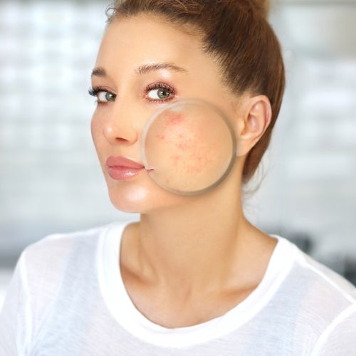 Laser for Acne Scars​